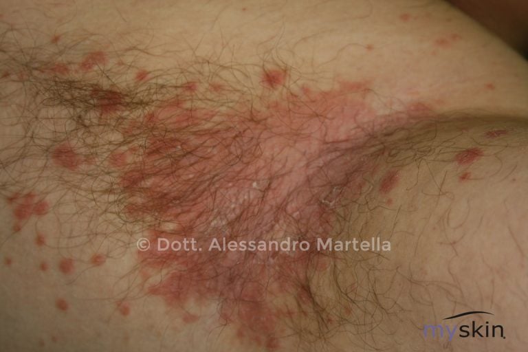 Qual è la differenza tra Psoriasi inversa e Intertrigine?