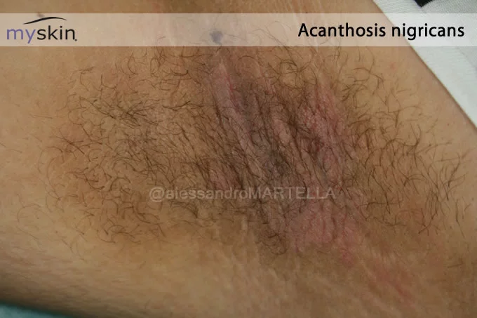 Acanthosis-nigricans