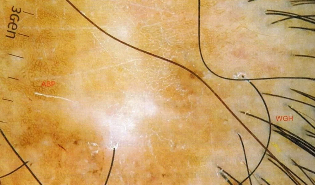 alopecia cicatriziale centrale centrifuga