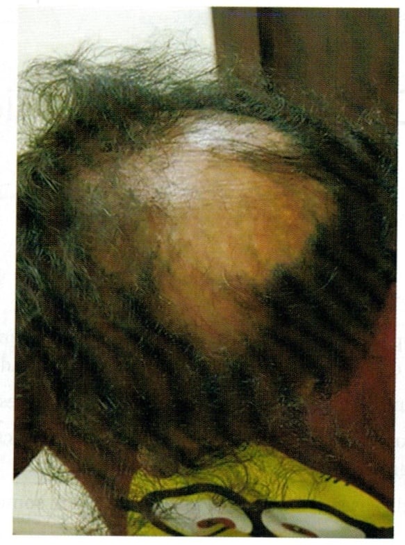 alopecia cicatriziale centrale centrifuga