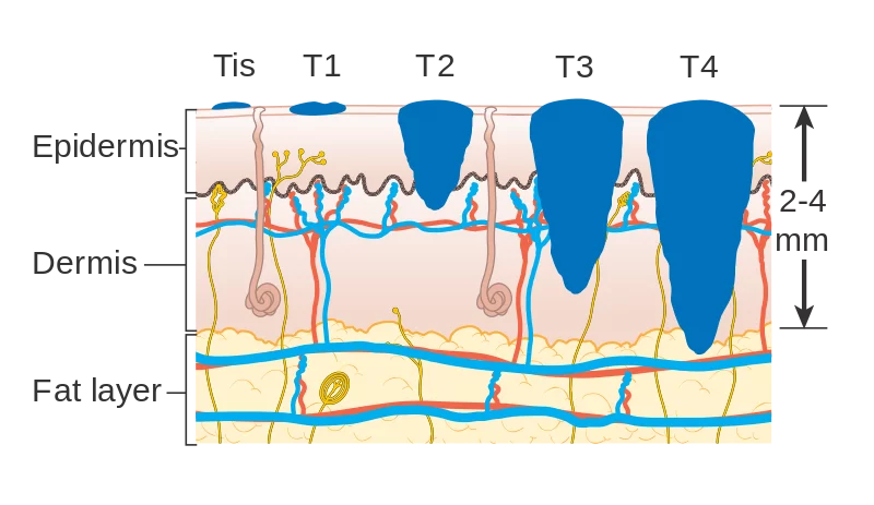 stadi-del-melanoma