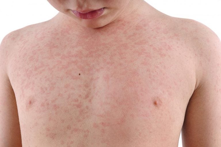 Rash maculopapulare: sintomi, tipi, cause e trattamento