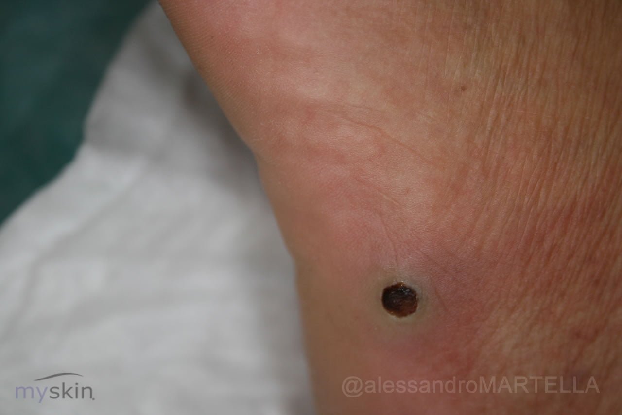 di Kaposi Myskin Dermatologi Online