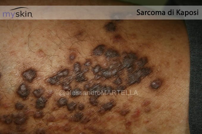 sarcoma-kaposi