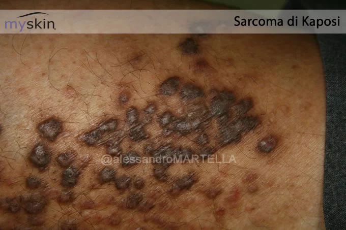 sarcoma-kaposi