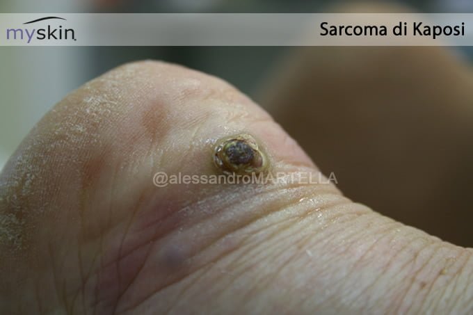 sarcoma_kaposi