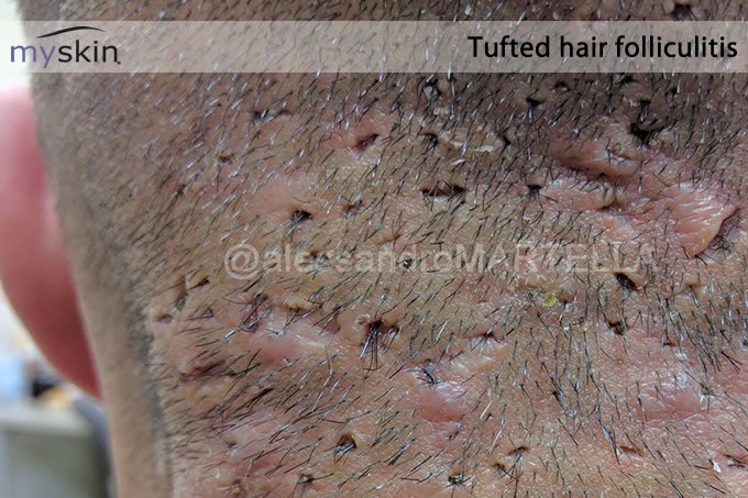 tufted hair folliculitis