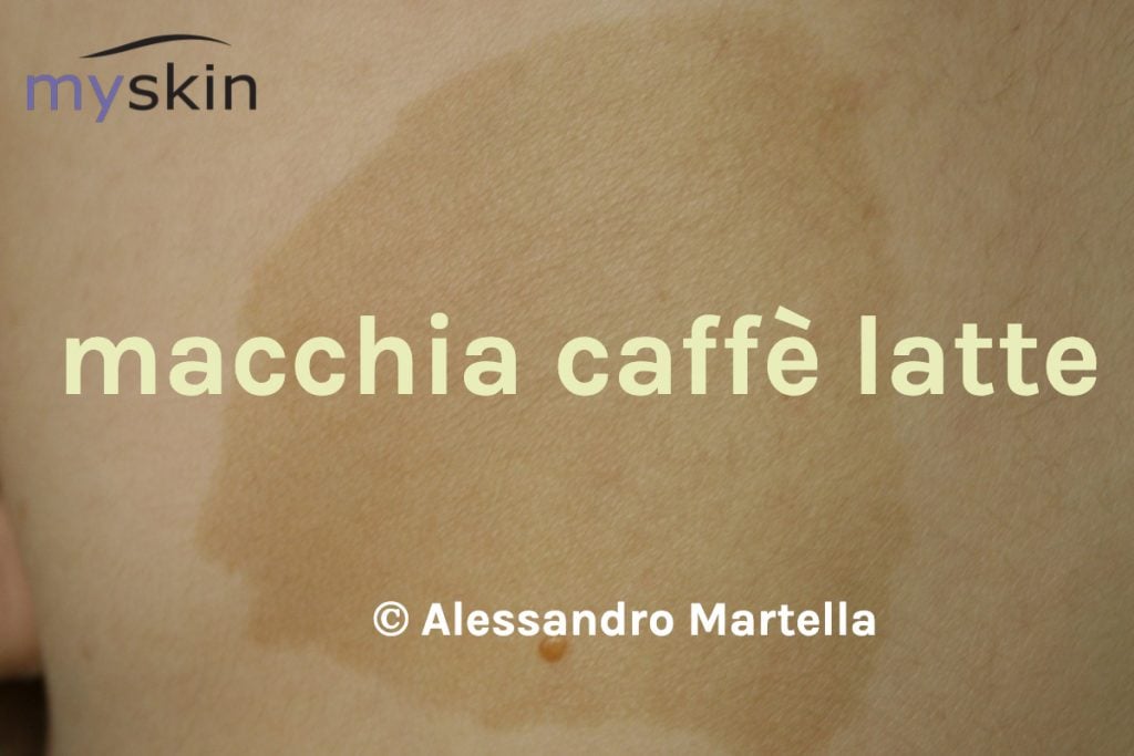 Macchia Caffè latte- Neurofibromatosi