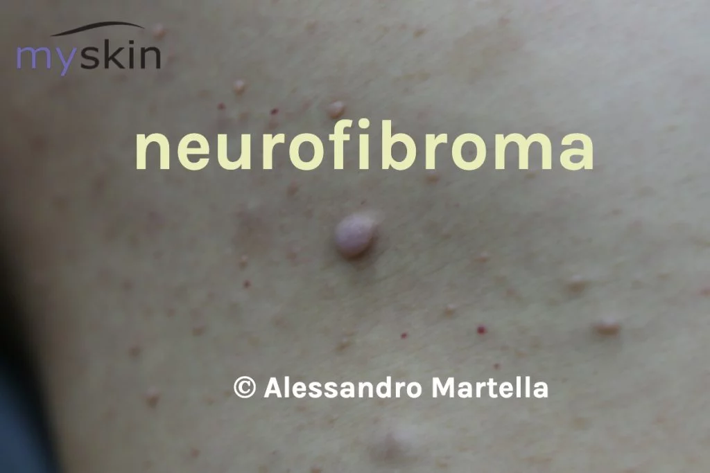 Neurofibroma cutanea di un paziente con Neufibromatosi cutanea