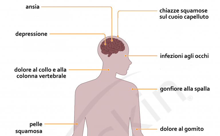 12 effetti dell’Artrite psoriasica sul corpo