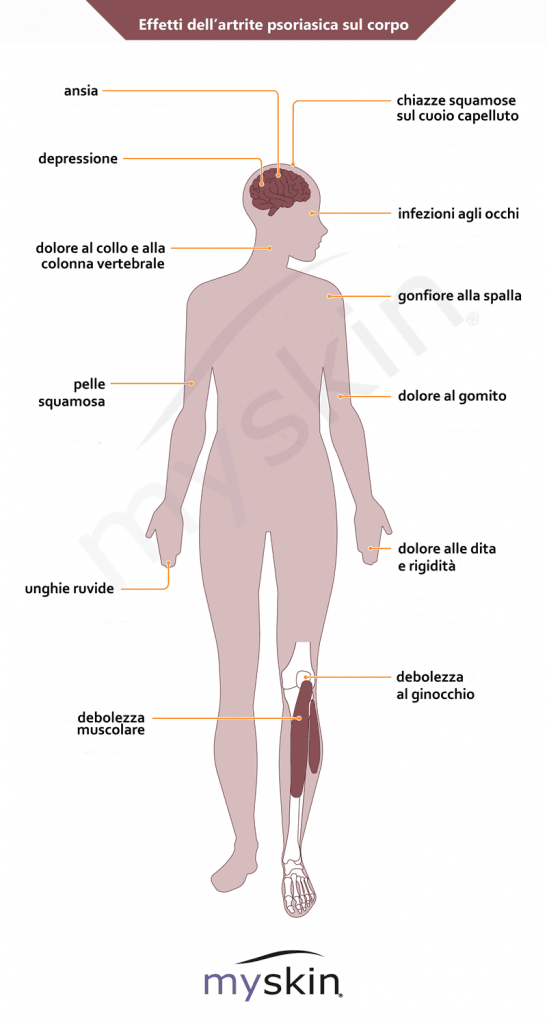 effetti artrite psoriasica