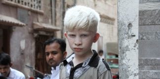 Albinismo: tipi, cause e sintomi albino