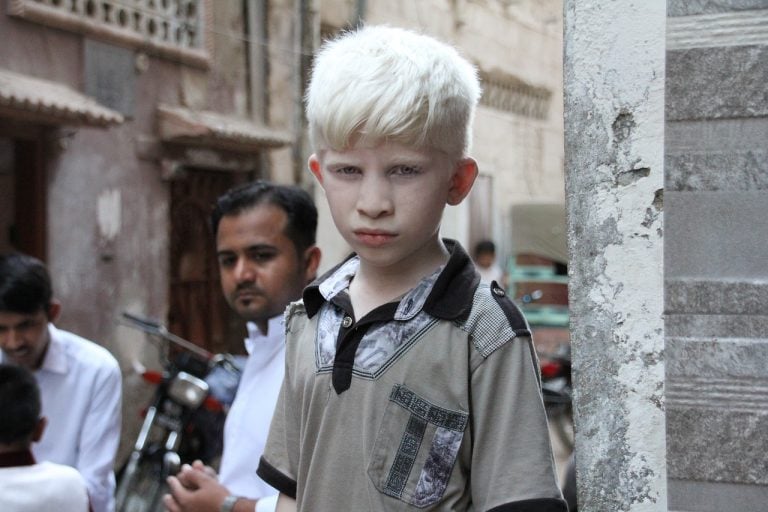 Albinismo: tipi, cause e sintomi