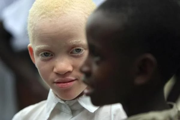 albino