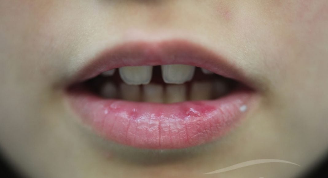 Cheilite l'infiammazione delle labbra Myskin Dermatologi Online