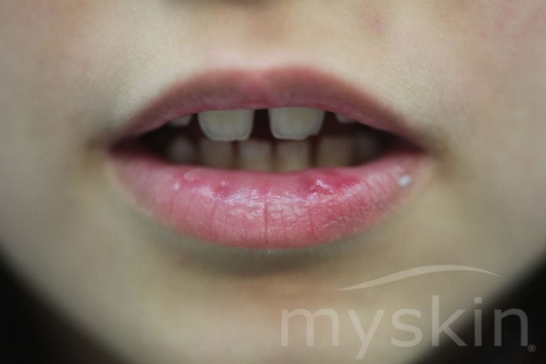Cheilite: l’infiammazione delle labbra