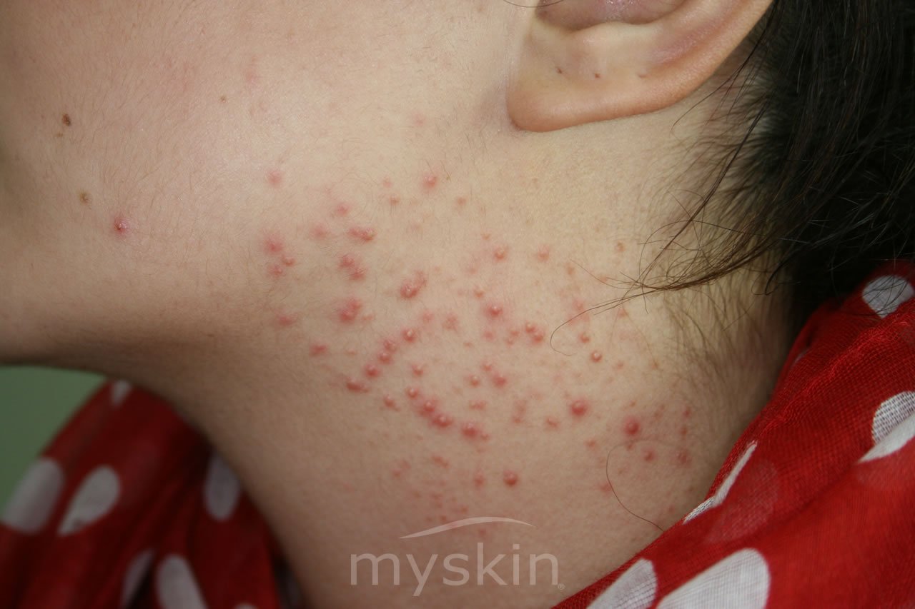 Follicolite Cause E Rimedi Myskin Dermatologi Online