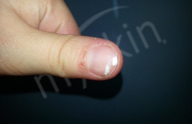 Macchie bianche sulle unghie: perchè compaiono?