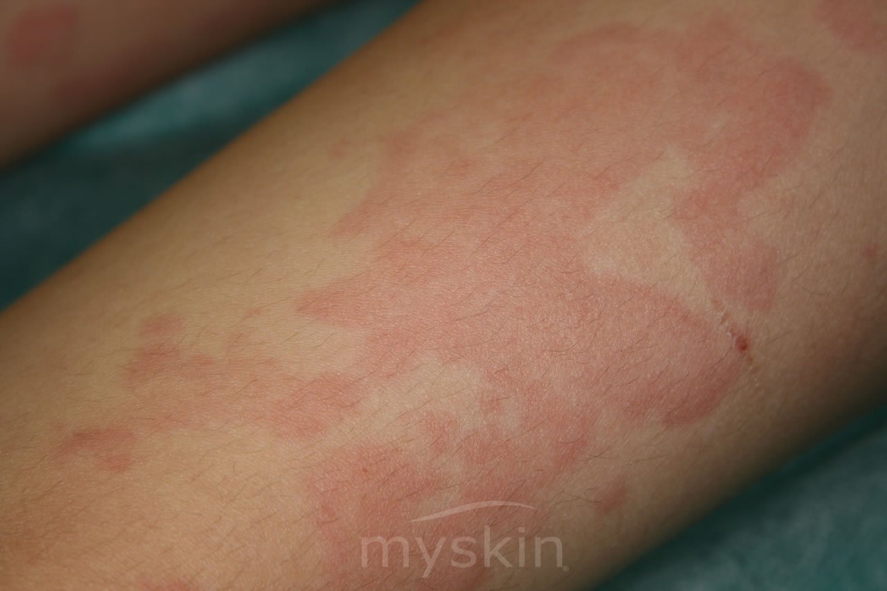 orticaria vasculitica bambini