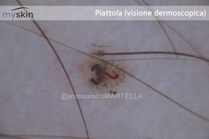 piattola-dermoscopica