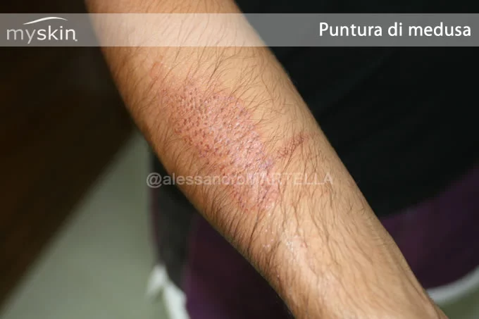 puntura-medusa-braccio