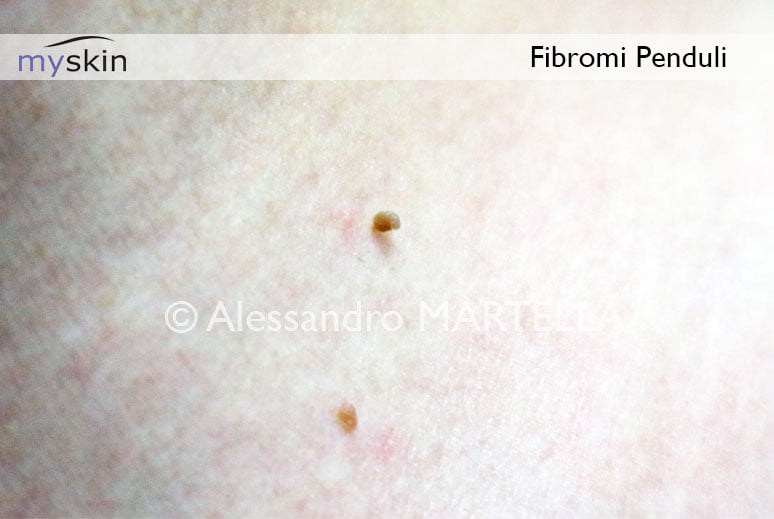 differenza tra papilloma e fibroma)