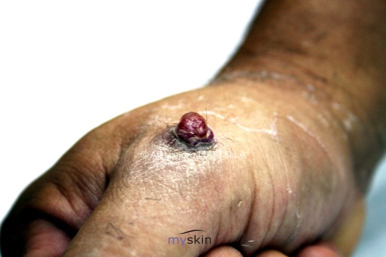 Tutto quello che c’è da sapere sul granuloma piogenico