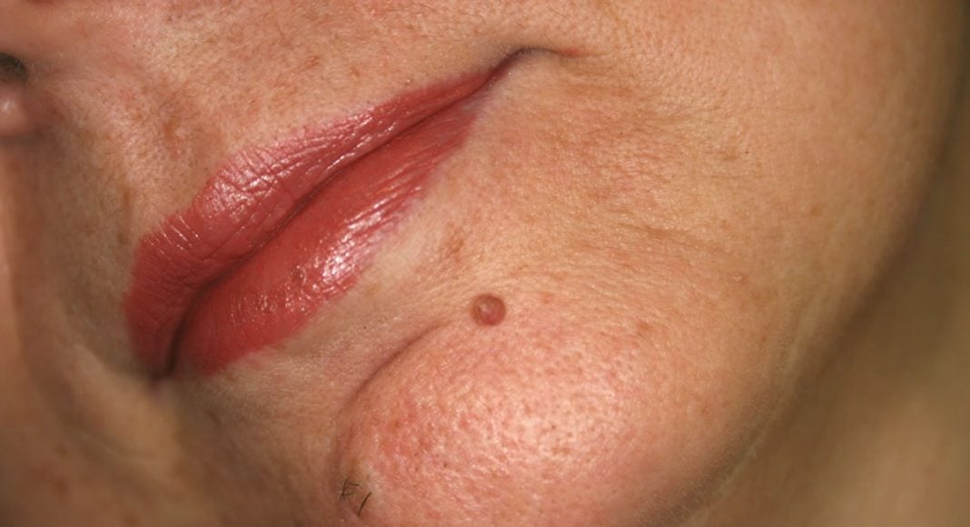 Tutto Quello Che Devi Sapere Sugli Emangiomi Myskin