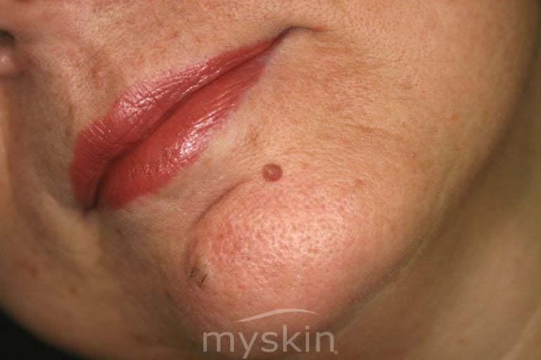 Tutto quello che devi sapere sugli emangiomi emangioma