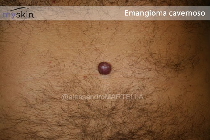 emangioma-cavernoso