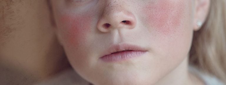 Quinta malattia: sintomi, diagnosi e trattamento