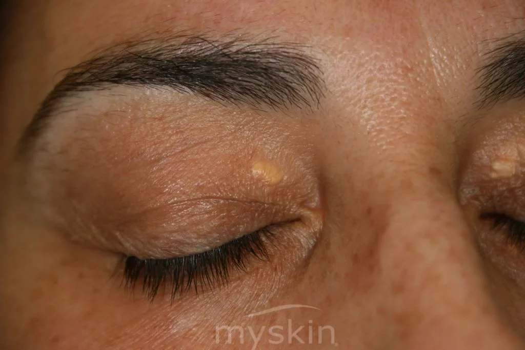 xantelasma