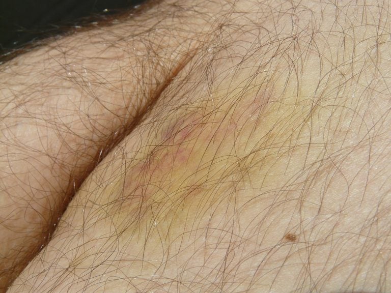 Lividi che si formano con facilità: scopriamo le cause