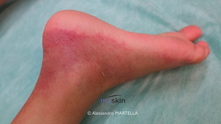 Petecchie : quelle macchie viola sulla pelle