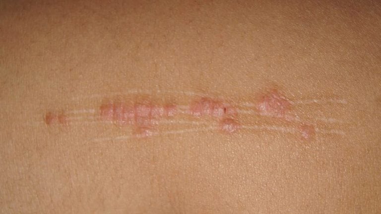 Il fenomeno di Koebner