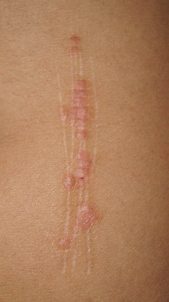 Il fenomeno di Koebner - Myskin - Dermatologi Online