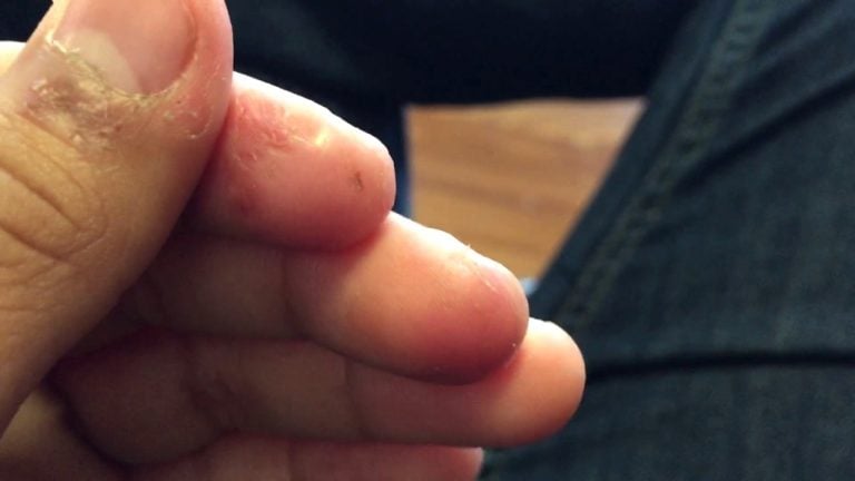 Dermatofagia: sintomi, cause e cura