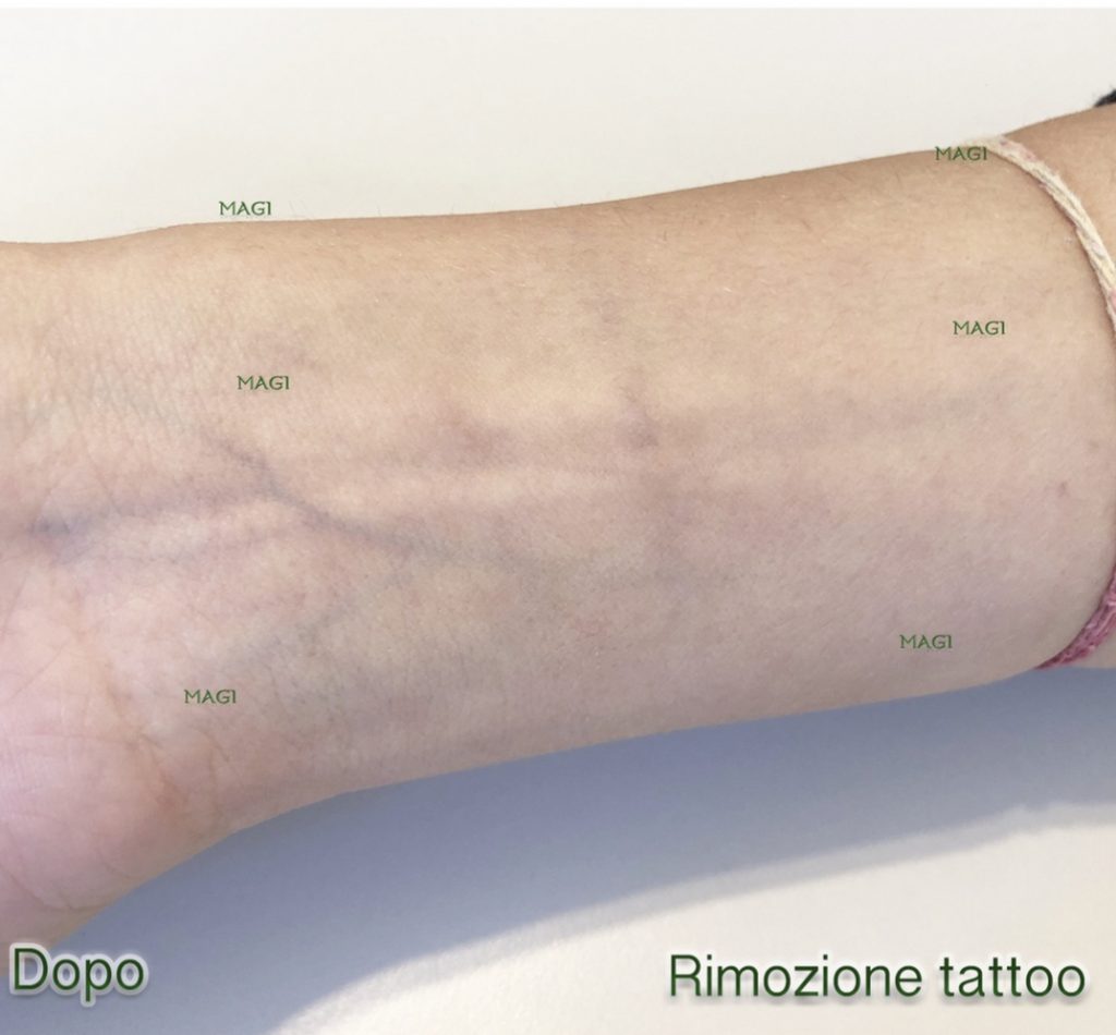Rimozione tattoo laser