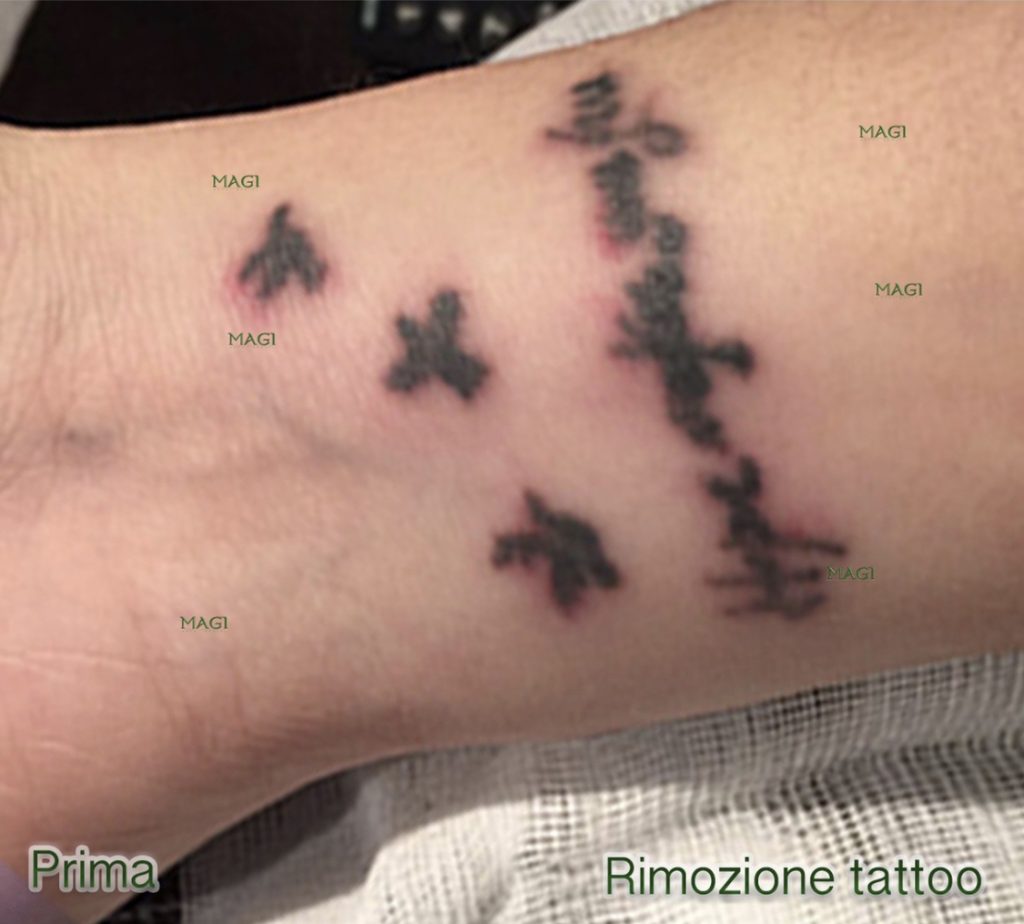 Rimozione tattoo laser 