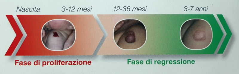 emangioma infantile-evoluzione