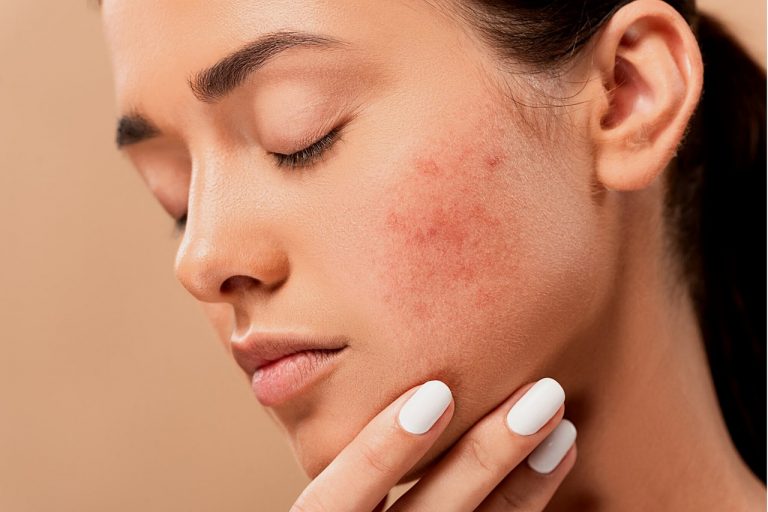 L’acido salicilico fa bene all’acne?