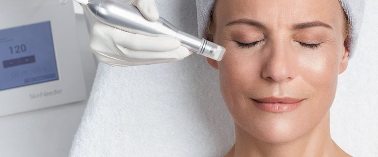 Cosa fa il microneedling per la tua pelle?
