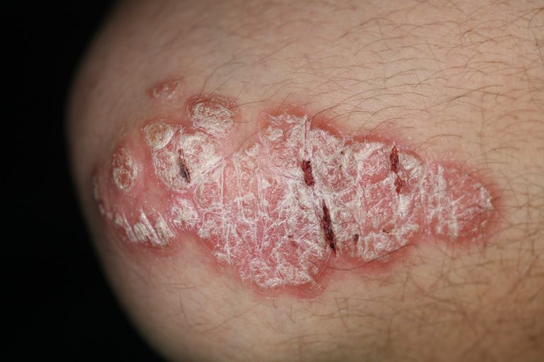 I farmaci biologici per la psoriasi possono aumentare il rischio di infezione grave